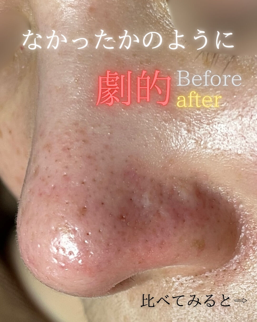 【福岡市】まるで別人級！黒ずみ毛穴が劇的にキレイになる理由！