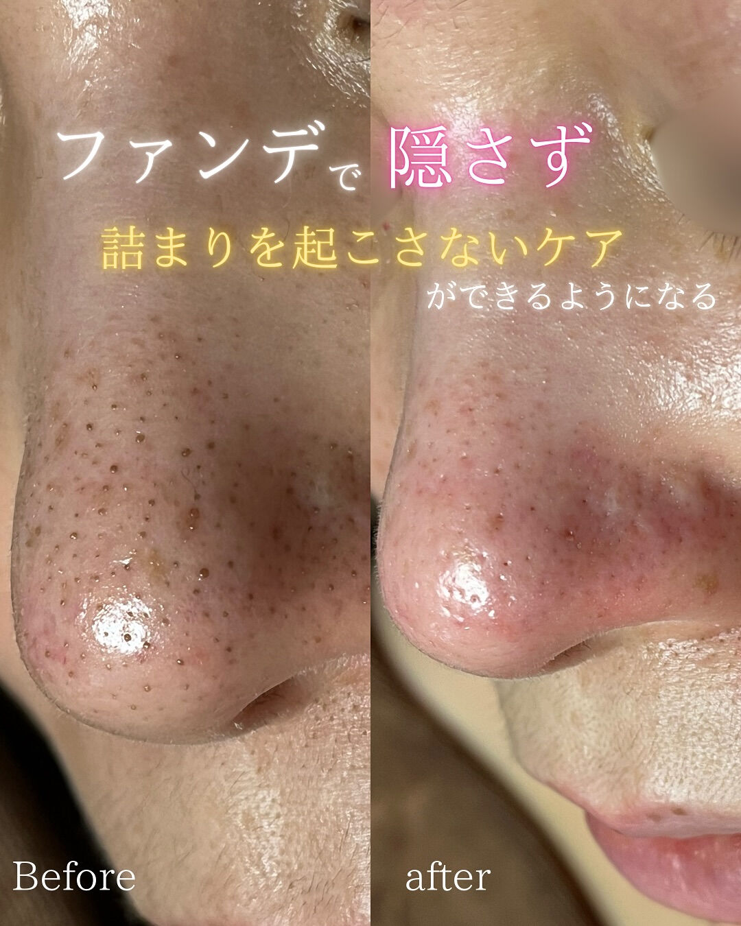 【福岡市】まるで別人級！黒ずみ毛穴が劇的にキレイになる理由！