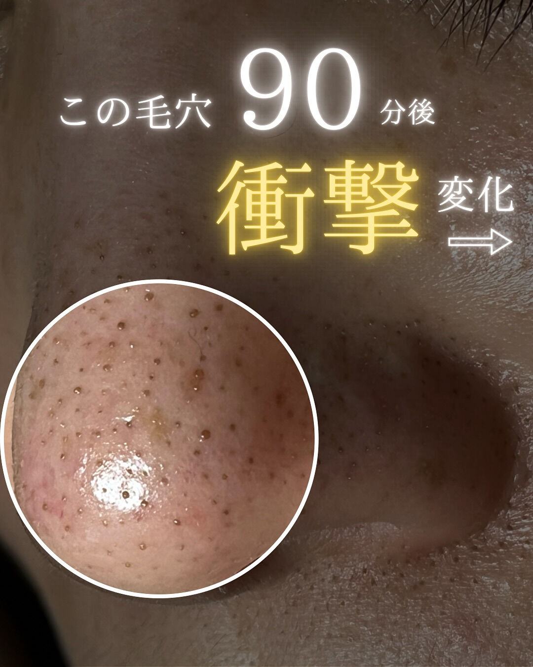 【福岡市】まるで別人級！黒ずみ毛穴が劇的にキレイになる理由！