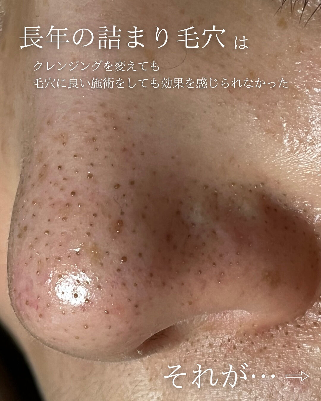 【福岡市】まるで別人級！黒ずみ毛穴が劇的にキレイになる理由！