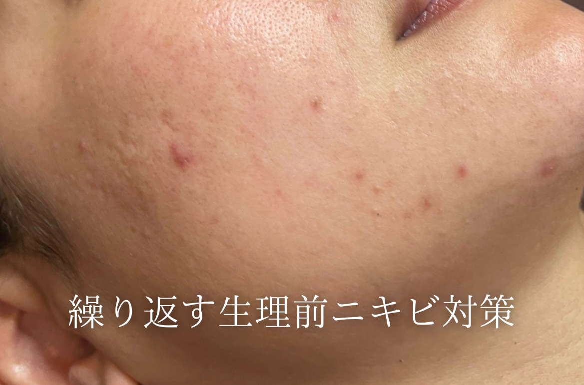 ✨肌荒れのピークは“黄体期”！ スキンケアでできる4つの強化ポイント💡